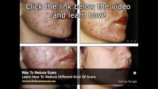 Watch Extreme Acne Treatment, Laser And Pus Fly Widely - Laser Acne Treatment
