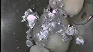 Class I Amalgam Restoration