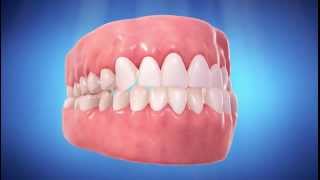 Gesunde Zähne sind gerade Zähne: Invisalign Straight Talk Video