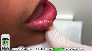 Great Dane's Popping a Lip Mucocele (Mouth Cyst?) Part Two
