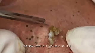 НОВОЕ Удаление и выдавливание чёрных точек! Чистка лица! Прыщи - выдавливание! Удаление прыщей!