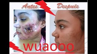 ▷▷ COMO ELIMINAR MARCAS Y CICATRICES  DEL ACNE ✅✅✅