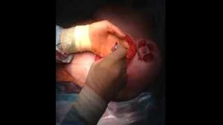 Vertical Breast Reduction Operation