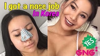 Plastic Surgery in Korea - Before&After Rhinoplasty Transformation! GNG Hospital