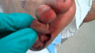 Traumatic Partial Toe Amputation