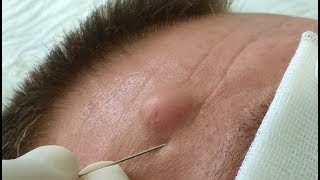 Sebaceous Cyst on Face.Атерома лица.