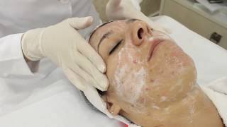 Já conhece o Protocolo para Tratamento Facial com a Linha Acne Shock?