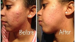 How I Got Rid Off My Acne + Before & After PICS at the end! Please WATCH!