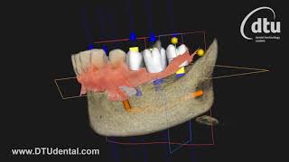 Carestream Dental CS Imaging Software 8 with CS 9600 CS 3600 implant meshing