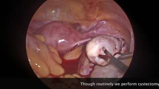 Ovarian Dermoid--- Small in Size