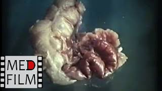 Аппендэктомия, острый аппендицит © Appendectomy
