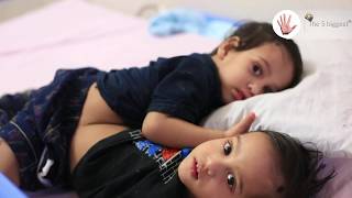 Conjoined Twins Love and Prince: Watch the Successful Separation! ~ Body Bizarre! CONJOINED Part4