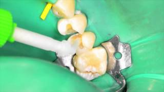 Cementation of a Glass Ceramic Inlay with RelyX™ Ultimate Adhesive Resin Cement