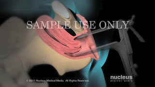 Hysteroscopy