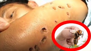 10 СМЕРТЕЛЬНО ОПАСНЫХ УКУСОВ НАСЕКОМЫХ