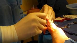 Transmetatarsal Amputation and TAL for Gangrene of Forefoot
