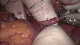 Лапароскопическая нефрэктомия Laparoscopic nephrectomy Hand assist