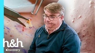 Acne muito ativa nas costas: cravos e cisto | Dra. Emma: Uma Questão de Pele | Discovery H&H Brasil