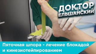 Пяточная шпора - лечение блокадой и кинезиотейпированием