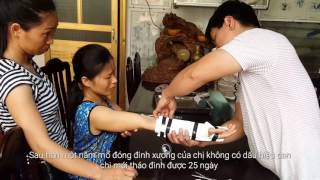 Chữa khỏi gãy xương sau khi đã mổ vít đinh hơn một năm nhưng xương không can tý nào