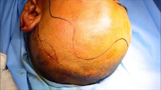 Frontal Sinus Fracture  fixation by Bicoronal flap