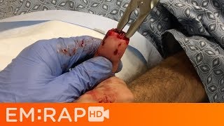 Bone Rongeur for Fingertip Amputations