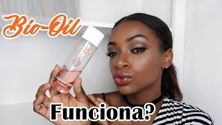Minha experiência com BIO-OIL / Estrias e marcas escuras! Mini resenha!