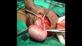 Testical Surgery