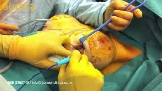 Intact PIP Implants Removal and Replacement Surgery