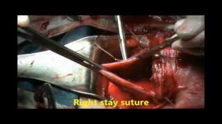 CESAREAN SECTION, step by step, by PROF. Dr. ARSHAD CHOHAN
