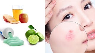 3 Cách Trị Mụn Trứng Cá Hiệu Quả Từ Thiên Nhiên