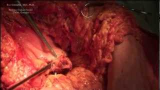 Whipple procedure ( Pancreatogastrostomy )