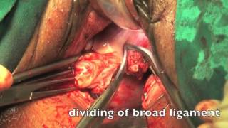Vaginal hysterectomy for the large uterus
