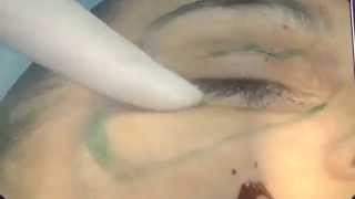 Липофиллинг зоны вокруг глаз - Lipofilling eye area. estet-portal.com