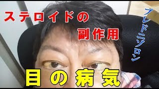 ステロイド(プレドニン・プレドニゾロン)と副作用 目の病気【体験談】