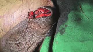 Partial Amputation Penis