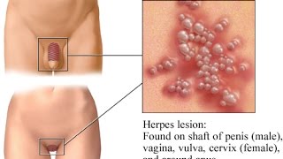 Herpes Simplex