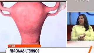 FIBROMAS UTERINOS, EN DOCTOR ABYA YALA