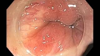 Anal canal - Cancer - Healed after chemoradiation