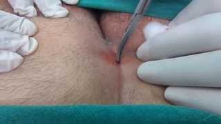 Bunches of Hair in Pilonidal Sinus; removal thereof