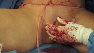 Fat Grafting to labia majora