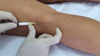 Escleroterapia de Varizes - O efeito espuma no tratamento das varizes
