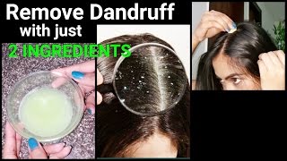 Magical Home Remedy to Remove DANDRUFF at home//Dandruff treatment/How to get rid of dandruff