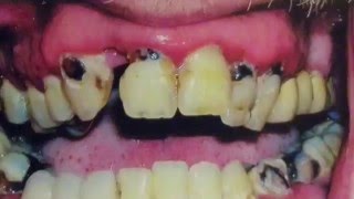 Базальная имплантация в Минске. Стоматолог Дмитрий Станевко.