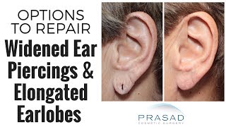 How Widened Ear Hole Piercings Can be Repaired with Stitching or Minor Surgery