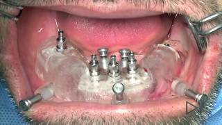 Dental Implant Surgery: Teeth in a hour with open source software