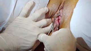 Marsupialization of Bartholin's Gland Cyst