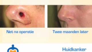 Huidkanker - De behandeling van verschillende soorten huidkanker