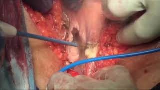 Robotic Extralevator Abdominoperineal Resection of Perianal Paget’s Disease with Anal Adenocarcinoma