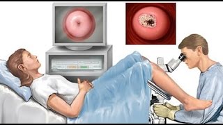 Consume 4 tablespoons of this EVERY DAY AND CANCER WILL DISAPPEAR!